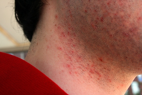 Прыщи после бритья: почему появляются на лице и как избавиться