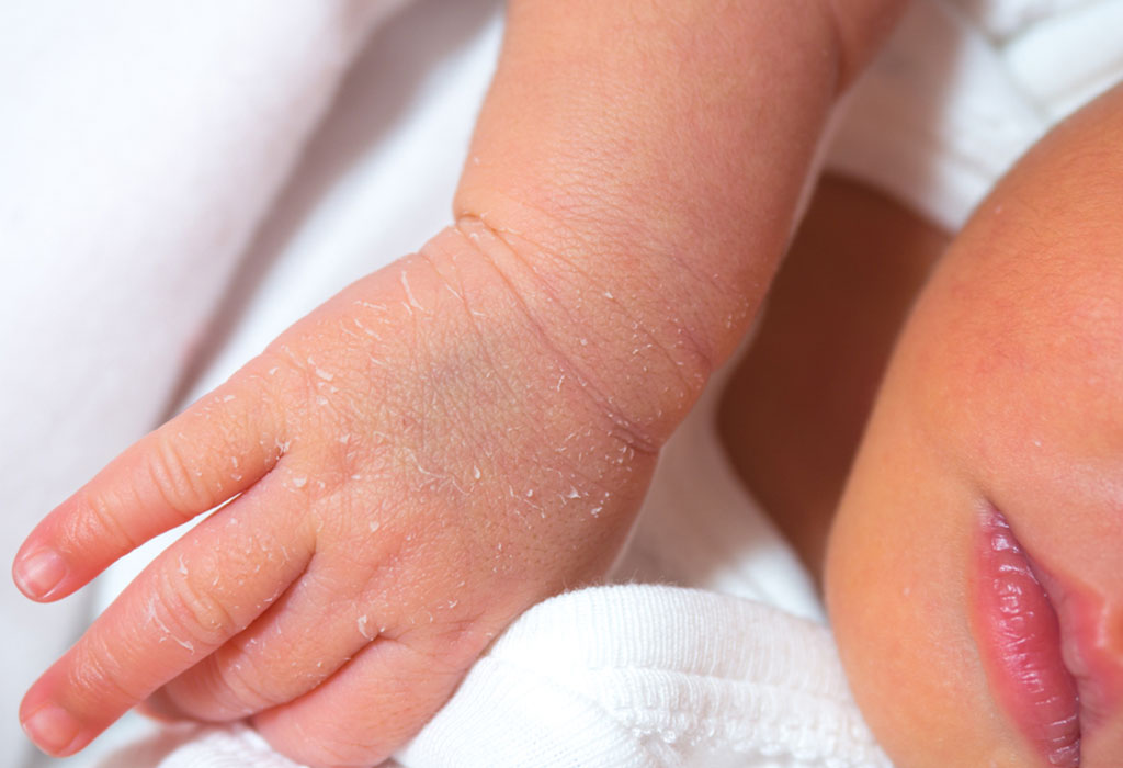 Сухая кожа у ребенка: 20 причин и 10 средств для ухода