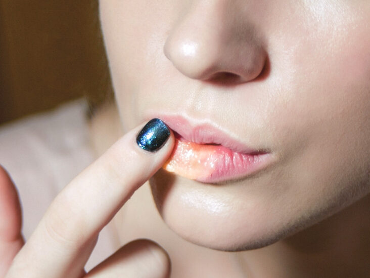 Почему трескаются губы – 10 причин и что делать
